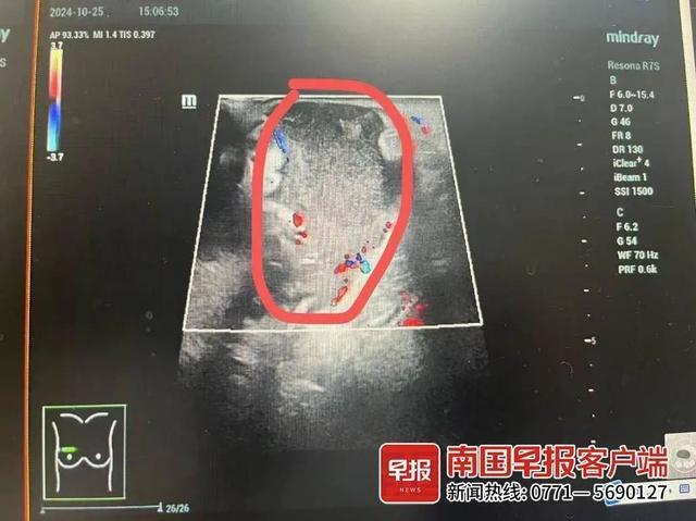 13岁男孩确诊乳腺炎非女性专属